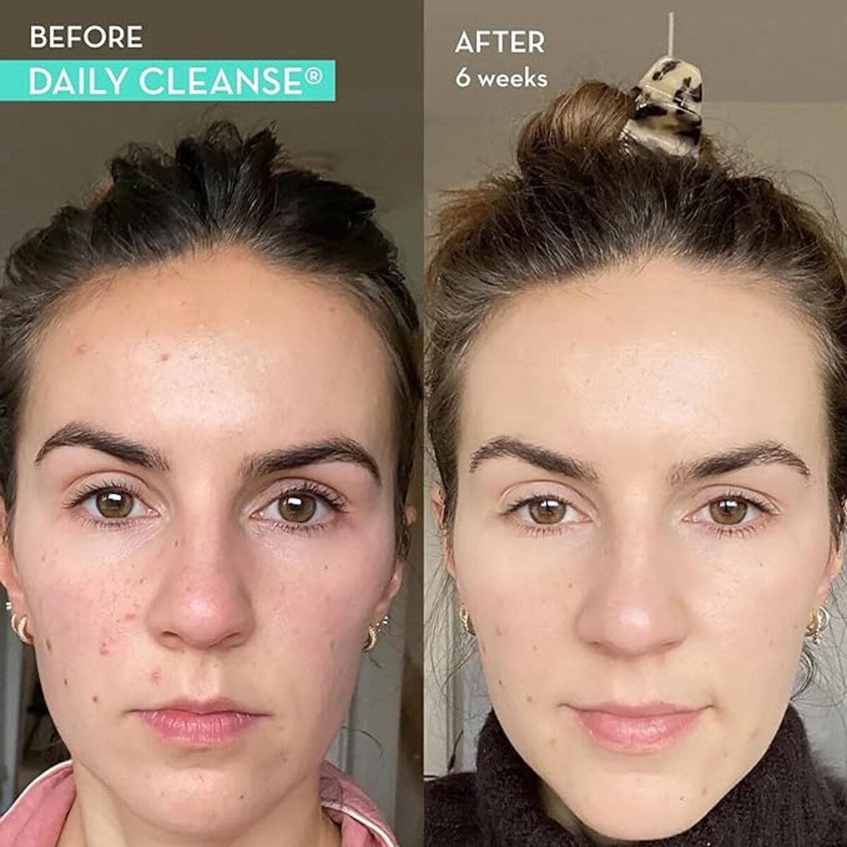 【追跡可能海外メール便】HUM Daily Cleanse Acne Supplements 30日分 デイリークレンズ ニキビケアサプリメント 消化改善サポート クロレラ・スピルリナ・オーガニック藻類・デトックスハーブ・ビタミン・ミネラル配合 美肌ケア
