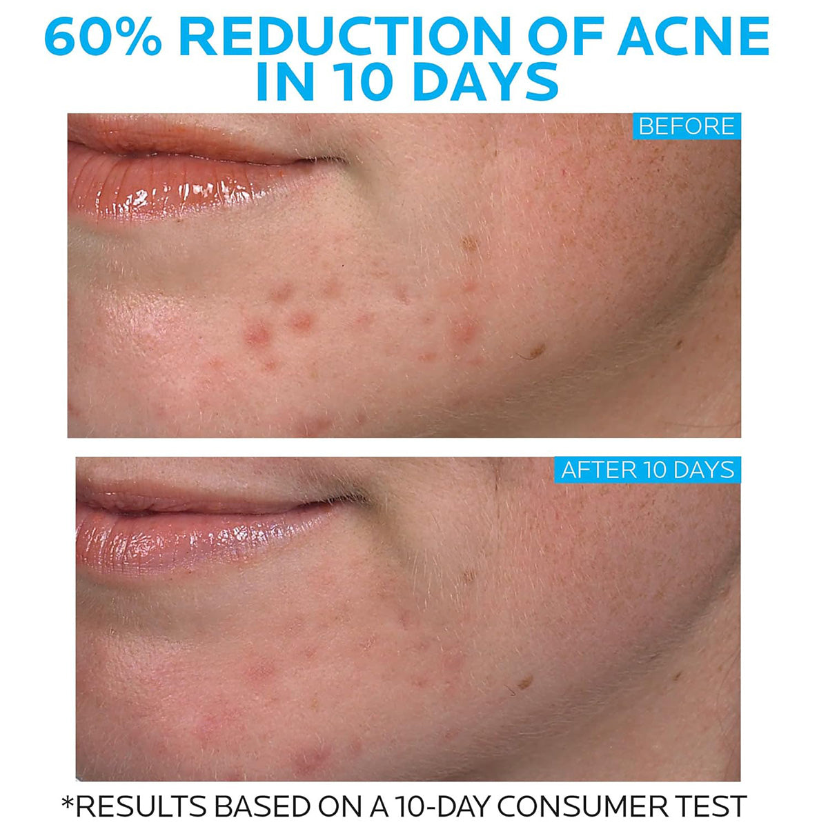 【追跡可能海外メール便】La Roche-Posay Effaclar Duo Dual Action Acne Spot Treatment Cream 0.7oz ラロッシュポゼ エファクラデュオデュアルアクションアクネスポットトリートメント 20ml