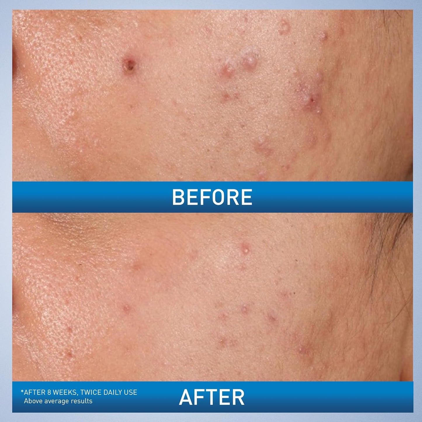 【追跡可能海外メール便】CeraVe Acne Control Gel 1.35oz c 40ml 美容 スキンケア にきび にきび跡 肌荒れ