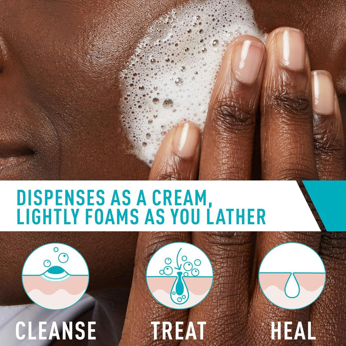 【追跡可能海外メール便】CeraVe Acne Foaming Cream Cleanser 5oz セラヴィ アクネ クレンジング 洗顔フォーム 150ml 美容 スキンケア にきび にきび跡 肌荒れ