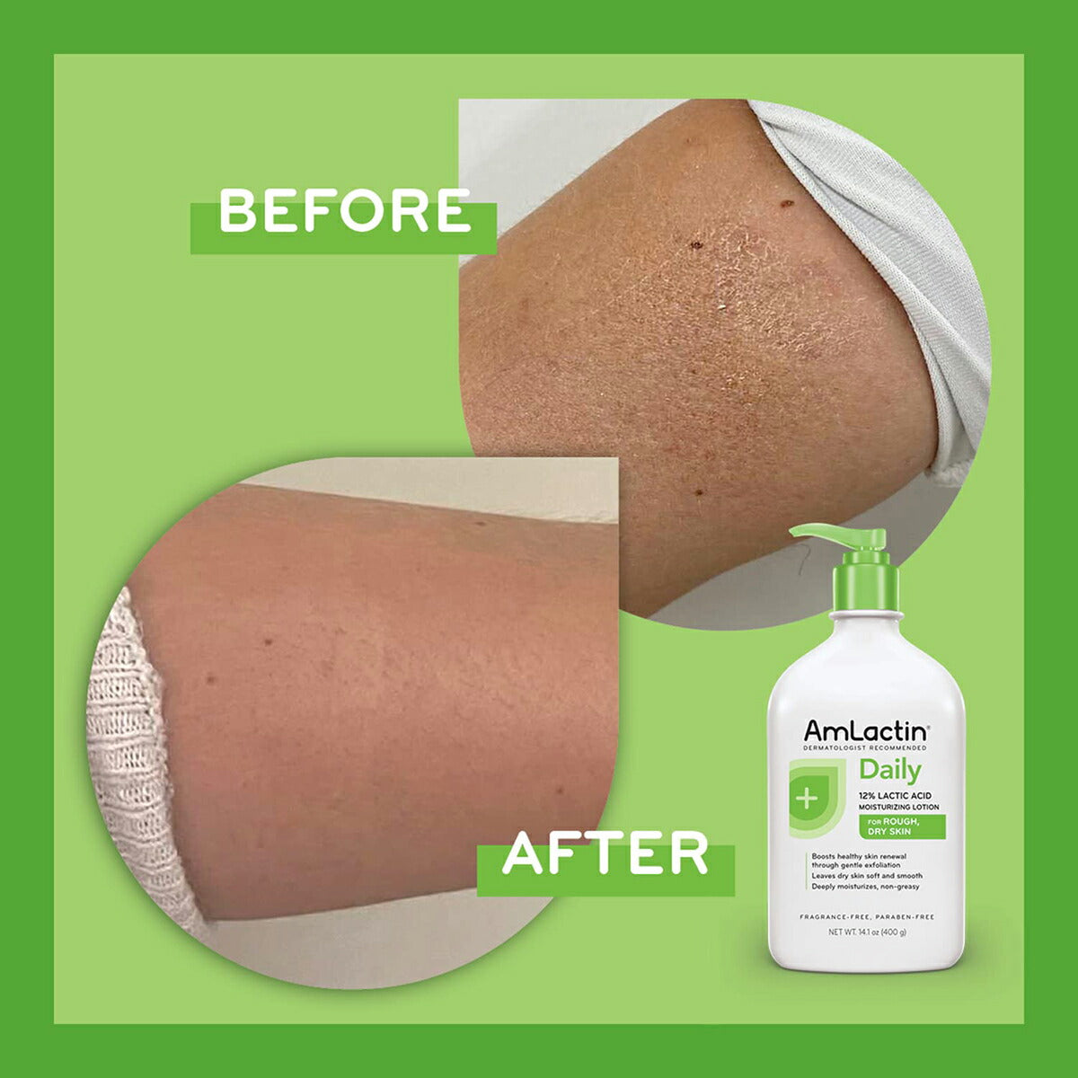 【エクスプレス便】AmLactin Daily Moisturizing Lotion for Dry Skin 14.1 oz アムラクティン デイリー モイスチャーライジング ボディーローション 乳酸 保湿 乾燥