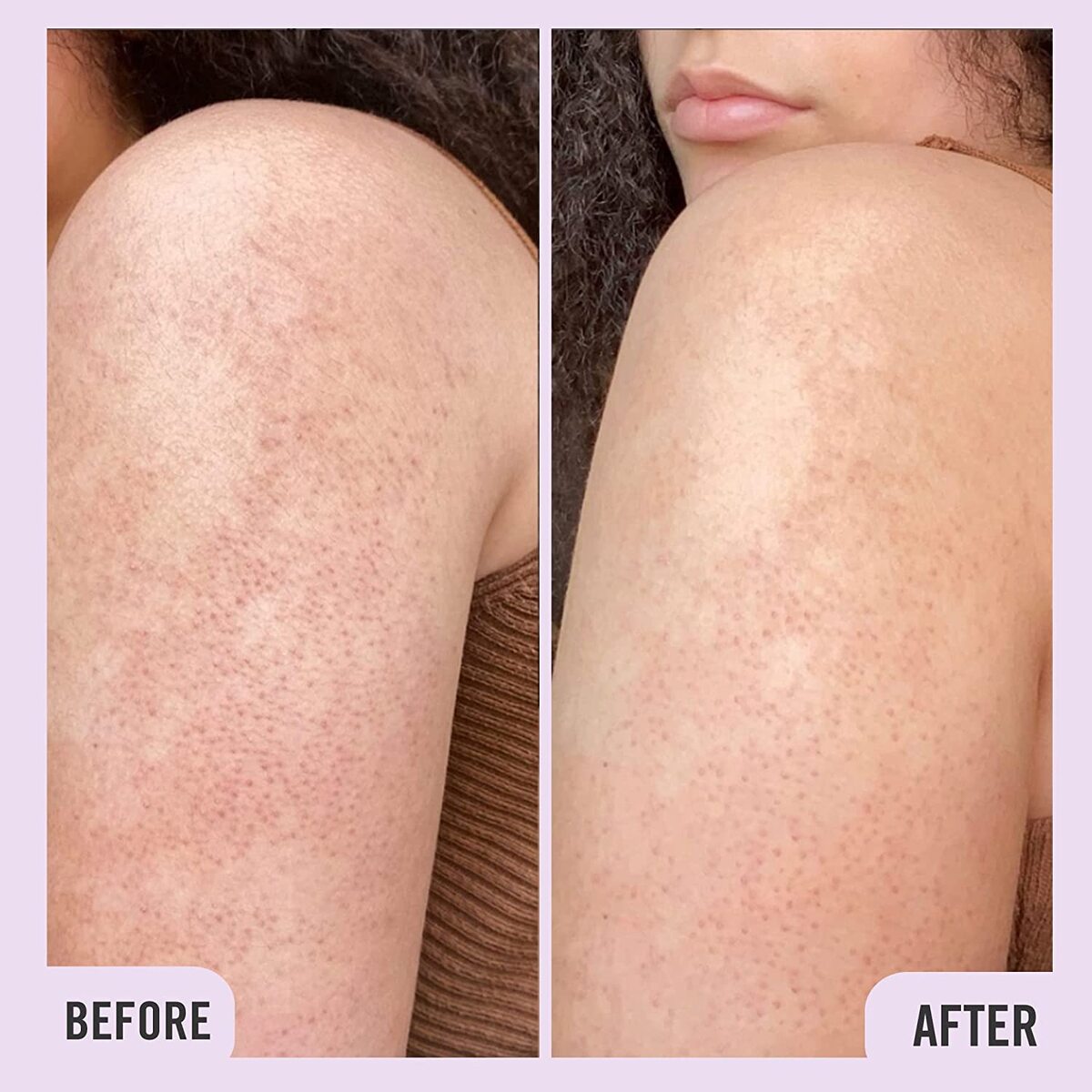 【エクスプレス便】First Aid Beauty KP Bump Eraser Body Scrub Exfoliant for Keratosis Pilaris with 10% AHA 4 ozファーストエイドビューティー 114g 肌のプツプツ解消ボディースクラブ 毛孔性苔癬改善 スクラブ スキンケア 美容