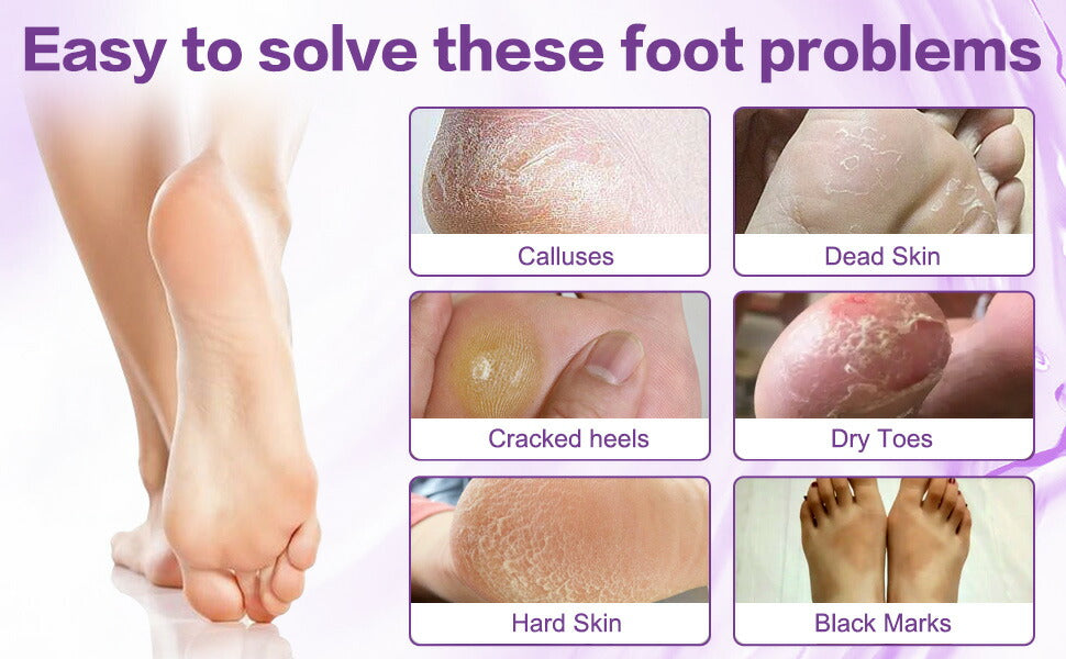 【追跡可能海外メール便】ALIVER Foot Peel Mask Exfoliator Peel Off Calluses Dead Skin Callus Remover Lavender1.41oz×3 Pack アリバー フットピールマスク エクスフォリエーター 足の角質 古い皮膚 ラベンダー40g×3パック