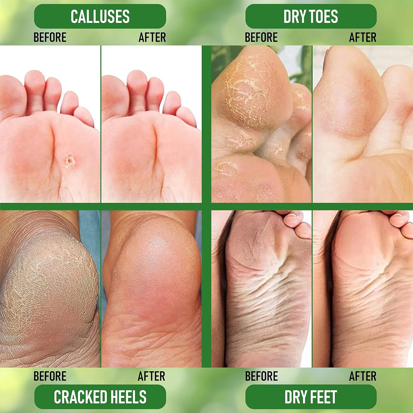 【エクスプレス便】PurOrganica Urea 40% Foot Cream Callus and Dead Skin Remover For Feet Elbows Hands and Knees 4ozピュアオーガニカ 尿素40%フットクリーム 足の角質および古い角質ケア 113g