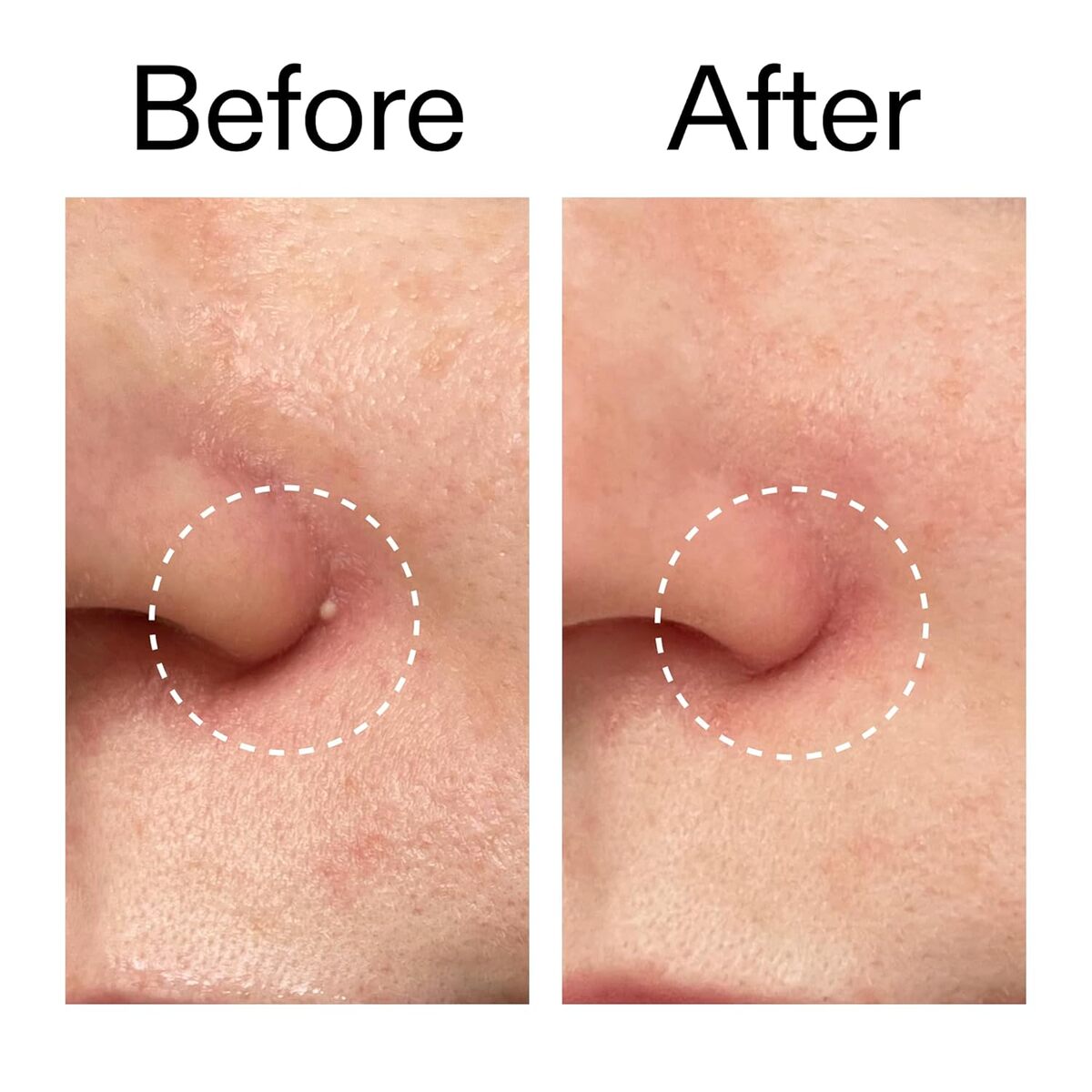 【エクスプレス便】The INKEY List ハイドロコロイド インビジブル ピンプル パッチズ ザインキーリスト Hydrocolloid Invisible Pimple Patches 0.09oz/約2.6g 22patches ニキビパッチ ニキビケア 透明 ハイドロコロイド