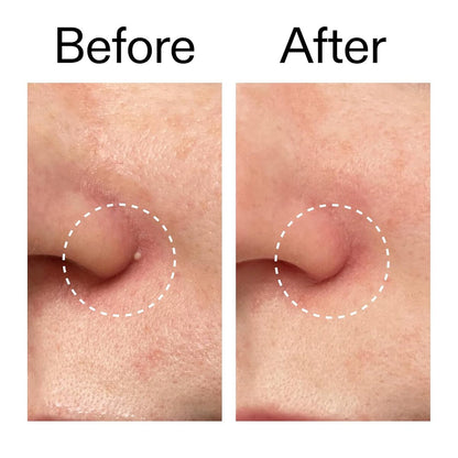 【エクスプレス便】The INKEY List ハイドロコロイド インビジブル ピンプル パッチズ ザインキーリスト Hydrocolloid Invisible Pimple Patches 0.09oz/約2.6g 22patches ニキビパッチ ニキビケア 透明 ハイドロコロイド