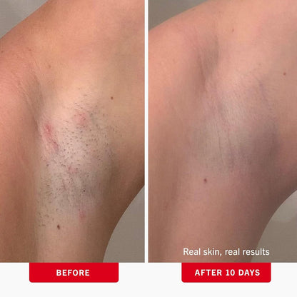 【エクスプレス便】 First Aid Beauty BHA + AHA配合の埋没毛パッド ファーストエイドビューティー Ingrown Hair Pads with BHA + AHA 28Pads 0.99oz/約29ml 拭き取りパット 毛穴 ブツブツ ケア