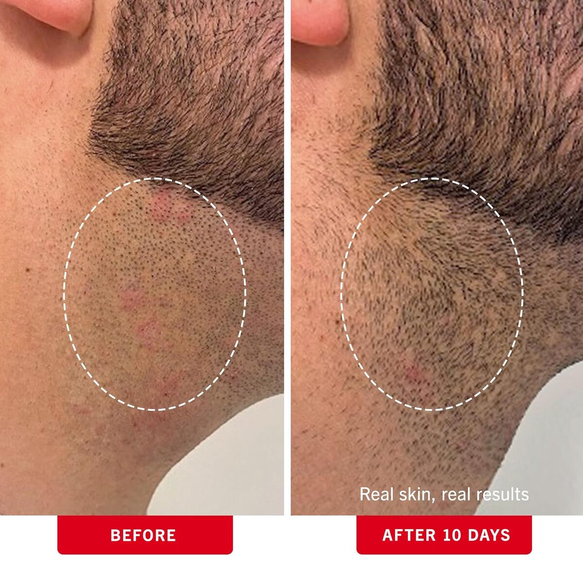 【エクスプレス便】 First Aid Beauty BHA + AHA配合の埋没毛パッド ファーストエイドビューティー Ingrown Hair Pads with BHA + AHA 28Pads 0.99oz/約29ml 拭き取りパット 毛穴 ブツブツ ケア