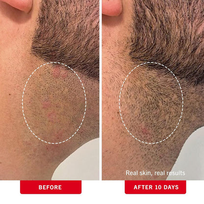 【エクスプレス便】 First Aid Beauty BHA + AHA配合の埋没毛パッド ファーストエイドビューティー Ingrown Hair Pads with BHA + AHA 28Pads 0.99oz/約29ml 拭き取りパット 毛穴 ブツブツ ケア