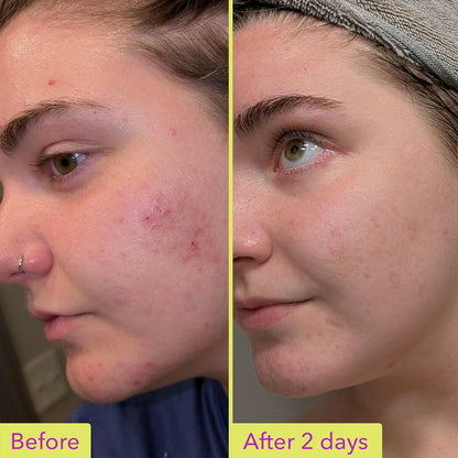 【追跡可能海外メール便】Good Molecules 10% アゼライン酸トリートメント 30ml   グッドモレキュールズ 10% Azelaic Acid Treatment 1oz